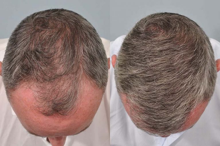 hair-transplant-6-months-post-op-Mark-Berry